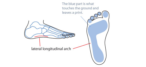 lateral arch support